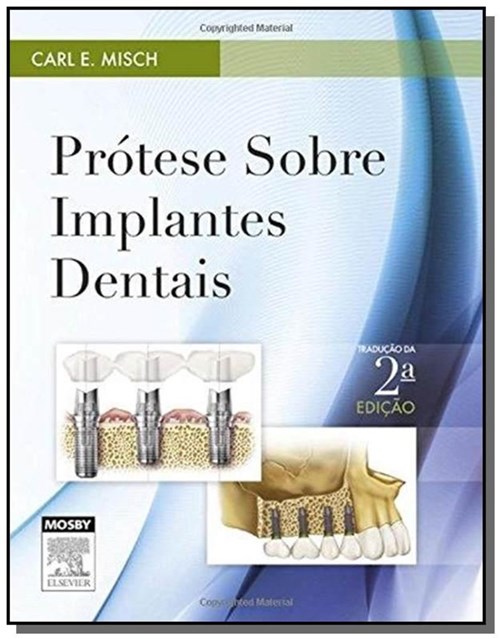 Protese Sobre Implantes Dentais